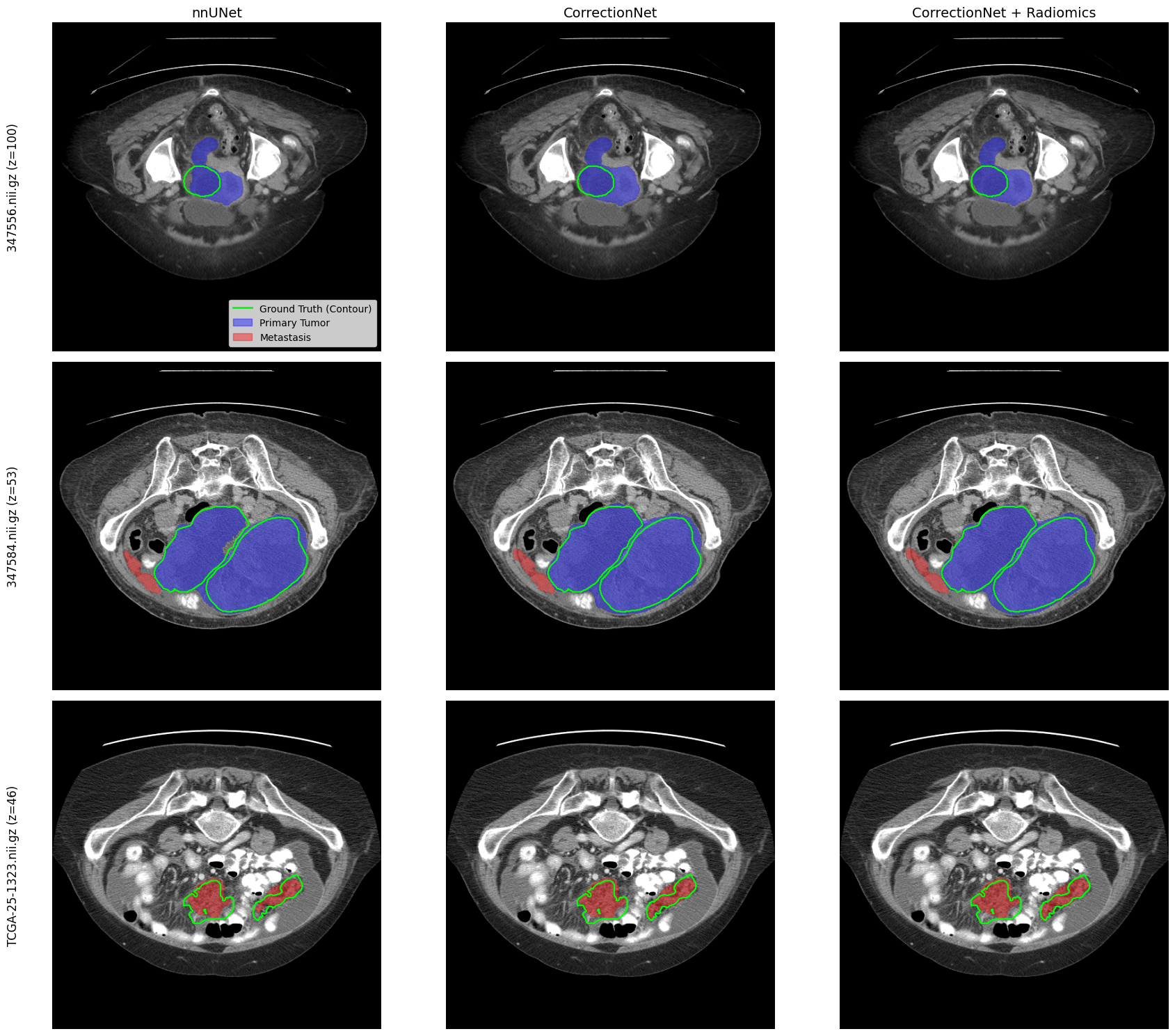 Ovarian Cancer Segmentation